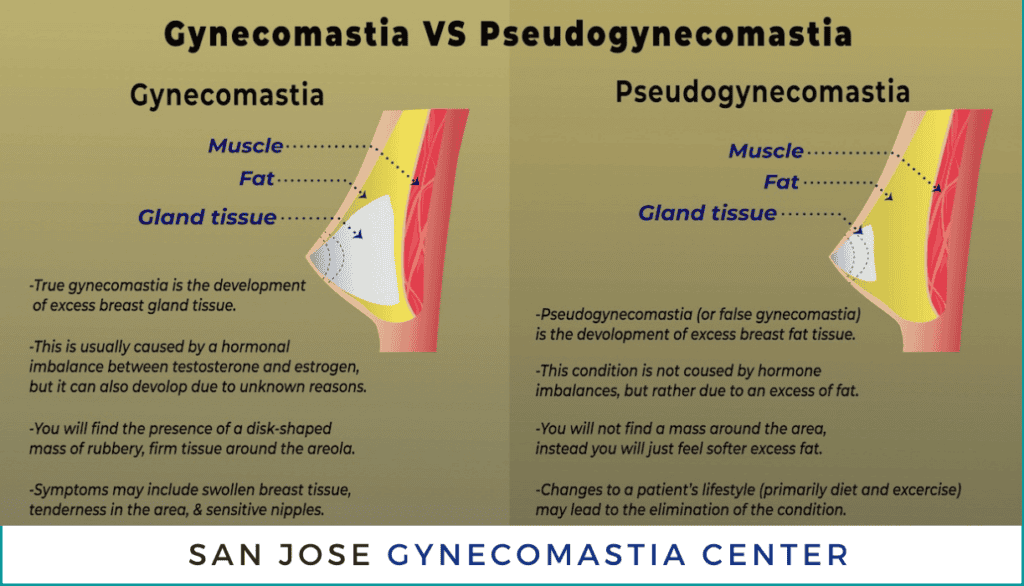 Gynecomastia vs. Pseudogynecomastia San Jose