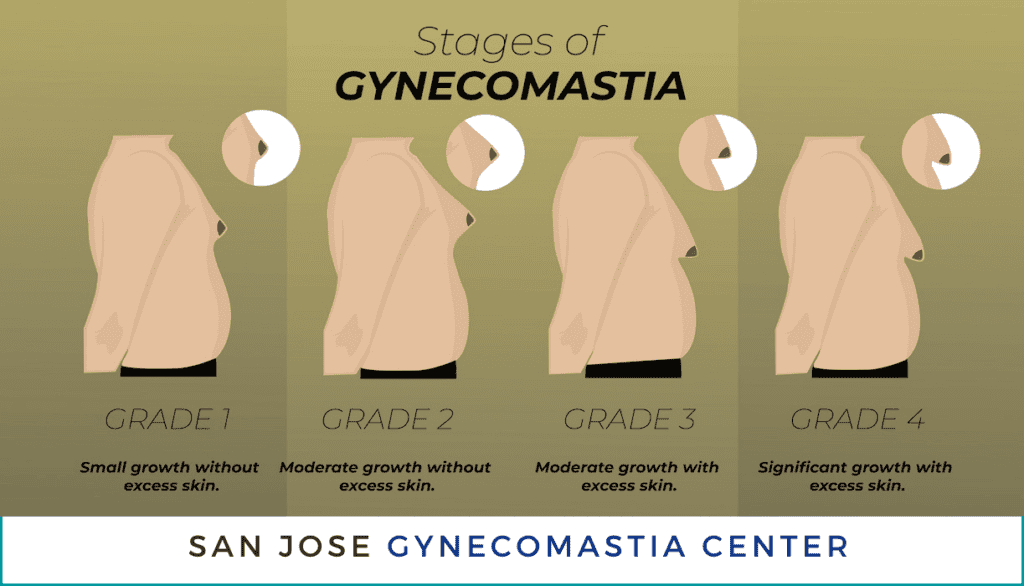 Stages and Grades of Gynecomastia San Jose