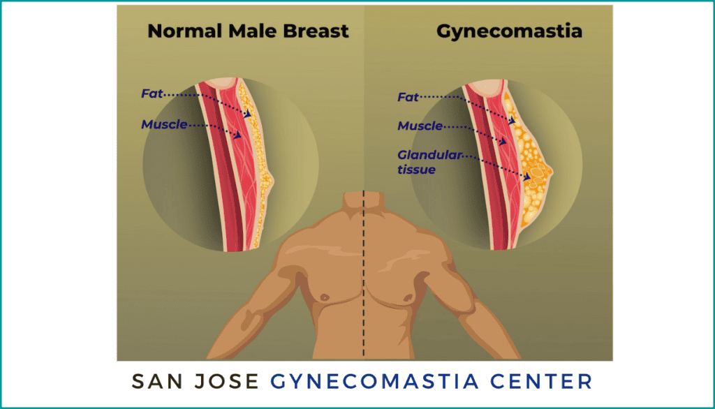 What is Gynecomastia San Jose